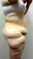 Dr. Mark Solomos Tummy Tuck Swelling Candidate Image Results