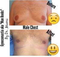 Gynecomastia Treatment Before After