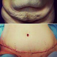 Tummy Tuck Uk Before And After Pictures