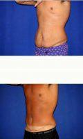 17 Or Under Year Old Man Treated With Tummy Tuck By Dr Joseph Mlakar, MD, Fort Wayne Plastic Surgeon
