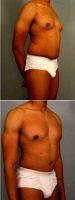 19 Year Old Man Treated With Tummy Tuck By Dr. Donald Nunn, MD, Atlanta Plastic Surgeon
