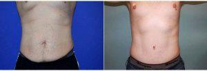 25 Year Old Male Full Abdomnioplasty With Dr Robert M. Kachenmeister, MD, Orange County Plastic Surgeon