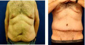 25 Year Old Man Treated With Tummy Tuck By Doctor Michael Hromadka, MD, Kalispell Physician