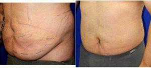 27 Year Old Man Treated With Tummy Tuck With Dr. Robert Peterson, MD, Honolulu Plastic Surgeon