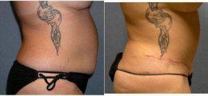 27 Year Old Woman Treated With Tummy Tuck And Flank Liposuction With Dr. Levi J. Young, MD, Overland Park Plastic Surgeon