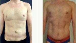 31 Year Old Man Treated With Tummy Tuck With Dr. Alex Campbell, MD, Colombia Plastic Surgeon