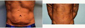 32 Year Old Male Treated With Tummy Tuck By Dr. Robert M. Kachenmeister, MD, Orange County Plastic Surgeon