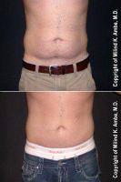 34 Year-old Male, Concerns With Lower Abdomen With Doctor Milind K. Ambe, MD, Orange County Plastic Surgeon