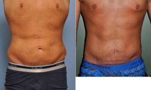 35 Year Old Male Treated For Abdominal Waistline Skin Roll After Weight Loss Before After With Dr Barry L. Eppley, MD, DMD, Indianapolis Plastic Surgeon (2)