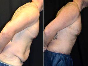 35 Year Old Man Treated With Tummy Tuck By Doctor B. Aviva Preminger, MD, New York Plastic Surgeon