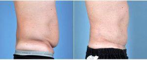 35 Year Old Man Treated With Tummy Tuck By Dr Thomas Hubbard, MD, FACS, Virginia Beach Plastic Surgeon