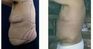 35 Year Old Man Treated With Tummy Tuck With Dr. Alex Campbell, MD, Colombia Plastic Surgeon