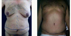 36 Year Old Man Treated With Tummy Tuck With Doctor Alex Campbell, MD, Colombia Plastic Surgeon