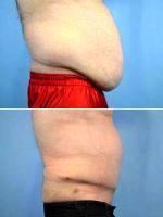 36 Year Old Man Treated With Tummy Tuck With Doctor Landon Pryor, MD, FACS, Rockford Plastic Surgeon