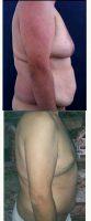 39 Year Old Man Treated With Tummy Tuck By Dr. Carolina Restrepo, MD, Colombia Plastic Surgeon