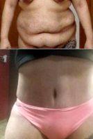 42 Year Old Man Treated With Tummy Tuck With Doctor Tania Medina De Garcia, MD, Dominican Republic Plastic Surgeon