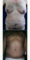 42 Year Old Man Treated With Tummy Tuck With Dr. Carolina Restrepo, MD, Colombia Plastic Surgeon