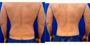 42 Year Old Man Treated With Tummy Tuck With Dr. Justin Yovino, MD, FACS, Beverly Hills Plastic Surgeon