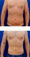 43 Year Old Man Treated With Tummy Tuck By Dr Justin Yovino, MD, FACS, Beverly Hills Plastic Surgeon