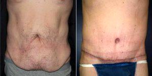 43 Year Old Man Treated With Tummy Tuck With Dr Kathleen Waldorf, MD, FACS, Portland Plastic Surgeon