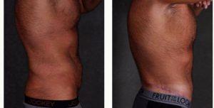 46 Year Old Man Treated With Tummy Tuck By Doctor Richard J. Bruneteau, MD, Omaha Plastic Surgeon