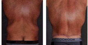 46 Year Old Man Treated With Tummy Tuck By Dr Richard J. Bruneteau, MD, Omaha Plastic Surgeon