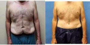48 Year Old Man Treated With Tummy Tuck With Dr. Arun Rao, MD, Tucson Plastic Surgeon