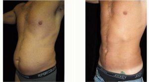 52 Year Old Man Treated With Tummy Tuck By Dr. Leon Goldstein, MD, Madison Plastic Surgeon