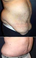 53 Year Old Man Treated With Tummy Tuck 3 4 Body Lift With Doctor Larry Weinstein, MD, Morristown Plastic Surgeon