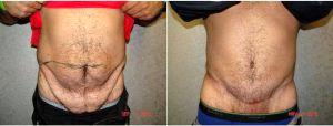 53 Year Old Man Treated With Tummy Tuck With Dr. Ira H. Rex Lll, MD, Fall River Plastic Surgeon