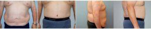55 Yr Old Male - Tummy Tuck With Doctor Keith C. Neaman, MD, Salem Plastic Surgeon