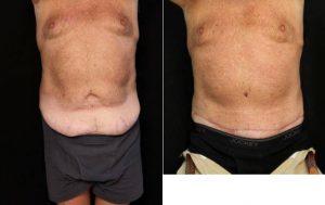 59 Year Old Male With Abdominoplasty (tummy Tuck) Before By Dr. Lawrence Scott Ennis, MD, FACS, Pensacola Plastic Surgeon Before And After (2)