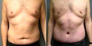 Abdominoplasty With Liposuction And Gynecomastia - 23 Year Old Male, 2 Months Post-op By Doctor Scott Barr, MD, Sudbury Plastic Surgeon