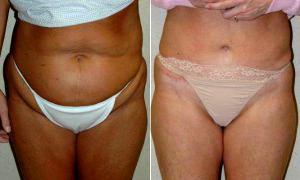 Abdominoplasty With Liposuction Of Hips And Flanks With Dr Eric T. Emerson, MD, FACS, Charlotte Plastic Surgeon