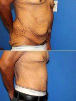 Doctor Joseph Ku, MD, Riverside Plastic Surgeon - Male Tummy Tuck After Massive Weight Loss