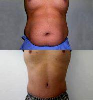 Doctor Michael Zarrabi, MD, Santa Monica Plastic Surgeon - Male Abdominoplasty Before After Photos (1)