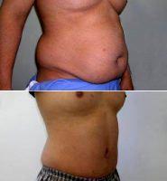 Doctor Michael Zarrabi, MD, Santa Monica Plastic Surgeon - Male Abdominoplasty Before After Photos (2)