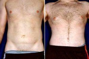 Doctor Stephen J. Ronan, MD, FACS, San Francisco Plastic Surgeon - Male Tummy Tuck Before And After (1)