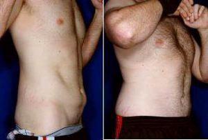 Doctor Stephen J. Ronan, MD, FACS, San Francisco Plastic Surgeon - Male Tummy Tuck Before And After (2)
