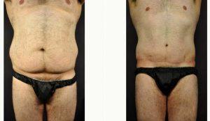 Doctor Terrence Higgins, MD, Las Vegas Plastic Surgeon - 44 Year Old Man Treated With Tummy Tuck