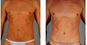 Dr Brian J. Lee, MD, Fort Wayne Plastic Surgeon - 50 Year Old Man Treated With Tummy Tuck
