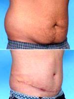 Dr Dan Mills, MD, Orange County Plastic Surgeon - 23 Year Old Male Treated With Abdominoplasty