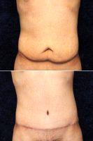 Dr Douglas L. Gervais, MD, Minneapolis Plastic Surgeon - 21 Year Male After Massive Weight Loss Before And After (1)