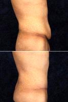 Dr Douglas L. Gervais, MD, Minneapolis Plastic Surgeon - 21 Year Male After Massive Weight Loss Before And After (2)