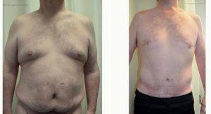 Dr Gregory Greco, DO, Red Bank Plastic Surgeon - 52 Year Old Man Treated With Tummy Tuck