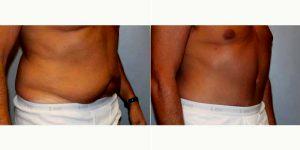 Dr Jeremy Pyle, MD, Raleigh-Durham Plastic Surgeon - 56 Year Old Man Treated With Tummy Tuck