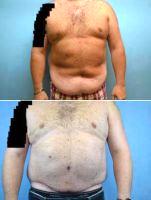 Dr Landon Pryor, MD, FACS, Rockford Plastic Surgeon - 43 Year Old Man Treated With Tummy Tuck And Liposuction To The Chest