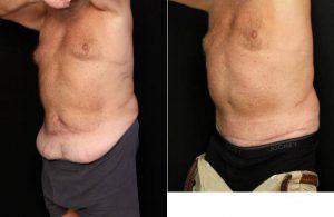 Dr Lawrence Scott Ennis, MD, FACS, Pensacola Plastic Surgeon - 59 Year Old Male With Abdominoplasty (tummy Tuck) Before After (1)