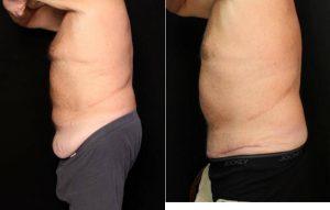 Dr Lawrence Scott Ennis, MD, FACS, Pensacola Plastic Surgeon - 59 Year Old Male With Abdominoplasty (tummy Tuck) Before After (2)
