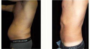 Dr Leon Goldstein, MD, Madison Plastic Surgeon - 53 Year Old Man Treated With Tummy Tuck